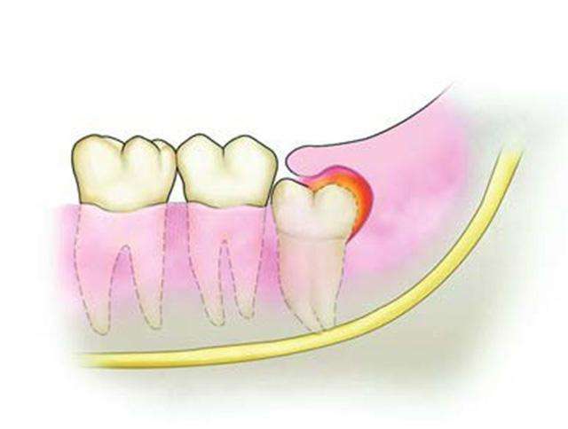智齿是什么意思