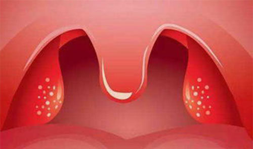 扁桃体发炎的症状 这5大表现中招了吗