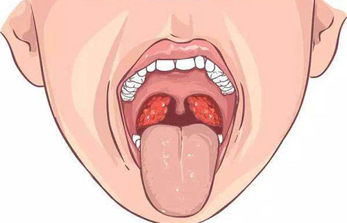 扁桃体发炎吃什么好 扁桃体发炎的饮食建议