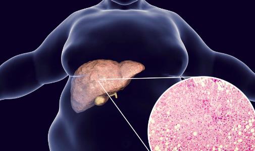 看起来不胖，肝脏可能早已被脂肪“包围”！查出脂肪肝怎