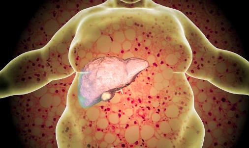 看起来不胖，肝脏可能早已被脂肪“包围”！查出脂肪肝怎