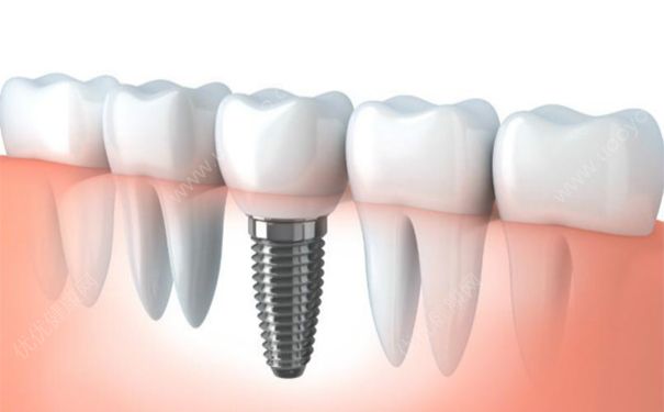 种植牙会不会痛？种植牙会过敏吗？(1)