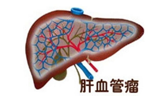 肝血管瘤严重吗？肝血管瘤的症状表现(1)