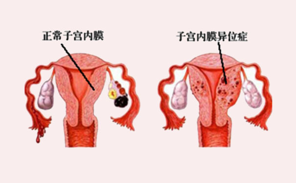 子宫内膜异位症能自然怀孕吗？子宫内膜异位症为什么影响怀孕？(1)