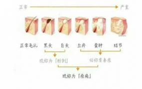 一定要了知道痘痘是如何形成的 挤痘痘的危害有什么呢