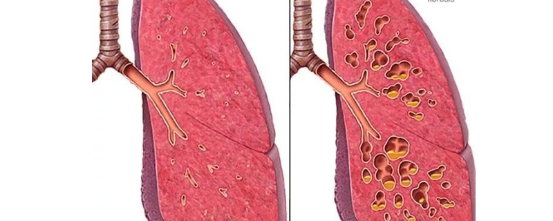 囊性纤维化为什么不能接触