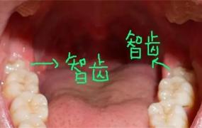 ​不是所有人都有智齿吗，智齿每个人都有吗