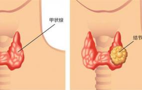 心情不好会增加甲状腺结节风险，心情差易患甲状腺结节吗